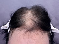 인천 연세모벨르의원 사이토카인 6개월 치료 | Koreas No.1 Hair Loss Community, DAEDAMO