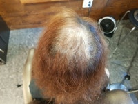 [여자증모술] 여자 증모술 이진헤어 증모술 시술사례 | 모발이식 후기, 리뷰, 비용은 대다모!