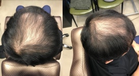 남자 정수리 탈모 이진헤어 증모술 시술 후기 [남자증모술] 남자 정수리 탈모 이진헤어 증모술 시술 후기 | 모발이식 후기, 리뷰, 비용은 대다모!