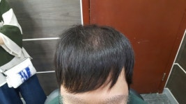 남자 앞머리 갈라짐과 정수리 이진헤어 원스텝증모 시술 [남자증모술] 남자 앞머리 갈라짐과 정수리 이진헤어 원스텝증모 시술 | 모발이식 후기... 