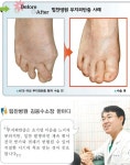 [건강]소리 없는 비명, 발 변형 질환｜동아일보 [건강]소리 없는 비명, 발 변형 질환