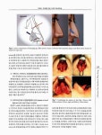 동양인코에서 삼각대구조의 재건 : 콧방울전진을 이용한 코끝 성형술 동양인코에서 삼각대구조의 재건 : 콧방울전진을 이용한 코끝 성형술 / 정재용
