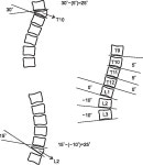 [PDF] Predictive Risk Factors for Refracture after Percutaneous Vertebroplasty | Semantic Scholar