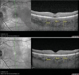 Failure to Integrate Quantitative Measurement Methods of Ocular Inflammation Hampers Clinical Practice and Trials on New... 