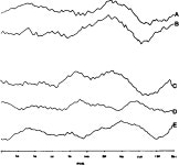 Palinopsia reconsidered | Semantic Scholar