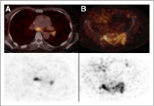 [PDF] Phase I Study of 68Ga-HER2-Nanobody for PET/CT Assessment of HER2 Expression in Breast Carcinoma | Semantic Scholar