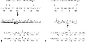 [PDF] Hereditary Spherocytosis Coexisting with UDP-Glucuronosyltransferase Deficiency Highly Suggestive of Crigler-Najjar...
