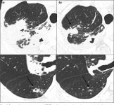 Figure 1 from How to Differentiate Inactive from Active Disease in Patients of Primary Multidrug-resistant Tuberculosis with... 