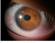 Outcomes of iris-claw anterior chamber versus iris-fixated foldable intraocular lens in subluxated lens secondary to Marfan... 