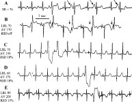 [PDF] Polymorphic ventricular tachyarrhythmias in the absence of organic heart disease: classification, differential diagnosis... 