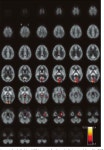 [PDF] A voxel-based PET investigation of the long-term effects of Ecstasy consumption on brain serotonin transporters.... 