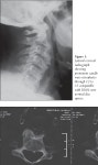 [PDF] respiratory Distress and Dysphagia Secondary to Diffuse Idiopathic Skeletal hyperostosis: Case report and review | Semantic... 