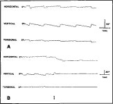 Pendular Nystagmus | Semantic Scholar