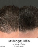 Dealing with hair loss? These before and after pics will shock you: This stem cell serum boosts new hair growth FAST - and youll... 