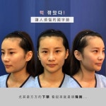 코재수술을 받았는데 입툭튀까지 해결하는 Magic🪄(리스펙성형외과 인중코 재수술)