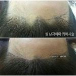 ᆞ 헤어라인타투는 본인의 머리카락이 흐르는결에 따라 터치를... 검색을 하다보면 고객님의 머릿결을 무시한 헤어라인문신사진을 보곤하는데... 
