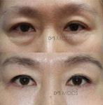 눈밑지방재배치 전후비교 ;모즈클리닉(모즈의원)