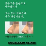 #더블킴클리닉#시자이너#가로수길#신사동#하이코#하이코후기#하이코시술#청담필러#필러잘하는곳#보톡스#코필러#하이코잘하는곳#김동욱원장... 