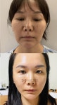 Clinic▪️ - #ModsClinic #PlasticSurgery #KoreanPlasticSurgery #KoreanPlasticSurgeon #minilifting #lifting #Wrinkle#모즈의… | 수술... 