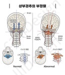 상부경추의 부정렬을 설명하는 메디컬일러스트 입니다. 프로필... 배포불가) #의학그림 #근육 #상부경추 #환축추아탈구 #턱관절 #TMJ... 