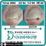 부평네일/손톱쟁이/부평네일아트/부평이달의아트 on Instagram: “#리그램 - @footnail_4316553 by @get_multi_repost 문제성 발 예방관리 No.1... 