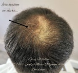 Pin page Épinglé par 지희 신 sur 헤어라인 | Micropigmentation capillaire, Cuir chevelu, Dermopigmentation
