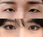 모즈의원:20_쌍꺼풀수술