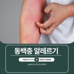 동백충 알레르기 증상과 치료법 및 예방하는 방법
