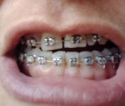 Pin page tratamento dental에 있는 핀