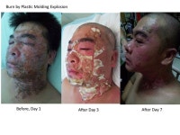 주네스글로벌영주센터 | 주네스: 체험 사례 | Jeunesse global, Severe burns, Jeunesse