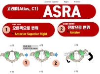 목뼈1번 아탈구, Atlas ASRA 목뼈 1번 아탈구 혹은 변위 : 아틀라스 ASRA 변위에 대하여