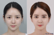 디에이성형외과 | 자연스러운