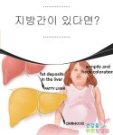 지방간이 있다면? - 건강을 위한 발걸음