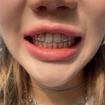 ✨🦷 ➿ 𝚃𝙾𝙾𝚃𝙷 𝙵𝙰𝙸𝚁𝚈 ➿🦷✨ 투스젬 on Instagram: “나비를 붙이셨던 @yoolrin 님이 새롭게... 