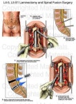 L4-5 L5-S1 Laminectomy and Spinal Fusion Surgery : Medical Chart- this is the closest to what surgery I will be having | 아나토미... 