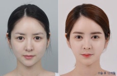 디에이성형외과 | 자연스러운