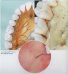 Anestesia | 치아