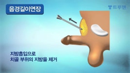 음경길이연장 수술 방법  - 트루맨남성의원 | Doovi 음경길이연장 수술 방법  - 트루맨남성의원