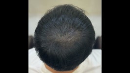 네이버 인플루언서 [네이버 인플루언서] 이진헤어 있어보이는 헤어스타일 #두피염색 #두피페인팅 #두피커버 #두피문신 #스칼프염색