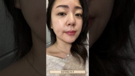 네이버 인플루언서 [네이버 인플루언서] 김형진베이직성형외과 얼굴지방흡입후기