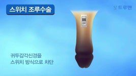 스위치 조루수술 (수술효과책임제) / 트루맨남성의원 | Doovi 스위치 조루수술 (수술효과책임제) / 트루맨남성의원