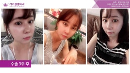 가미성형외과 리얼스토리영상 정송이 | Doovi 가미성형외과 리얼스토리영상 정송이