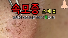 블랙헤드 심한사람들 이거바바 - LGBT 갤러리