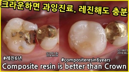 이분은 레진으로 다 된다시는데 맞음? - 치과 마이너 갤러리