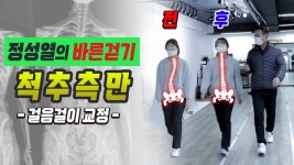 걸음자세 이거 보고 고쳐라 혁명이다 - 척추측만증 마이너 갤러리