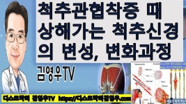 영상에서 통증 사라져도 신경 계속 눌려서 죽어갈수도 있다는건가? - 허리디스크 마이너 갤러리