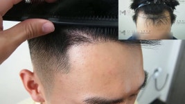 모재성 성형외과·모발이식센터 유튜브 채널 분석 보고서 - NoxInfluencer