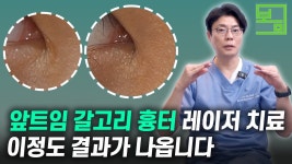 네이버 인플루언서 [네이버 인플루언서] 닥터봄의원 피부과의 수술흉터치료