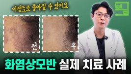 네이버 인플루언서 [네이버 인플루언서] 닥터봄의원 피부과의 모세혈관확장증
