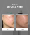 아크니케어코리아 - YouTube 아크니케어코리아